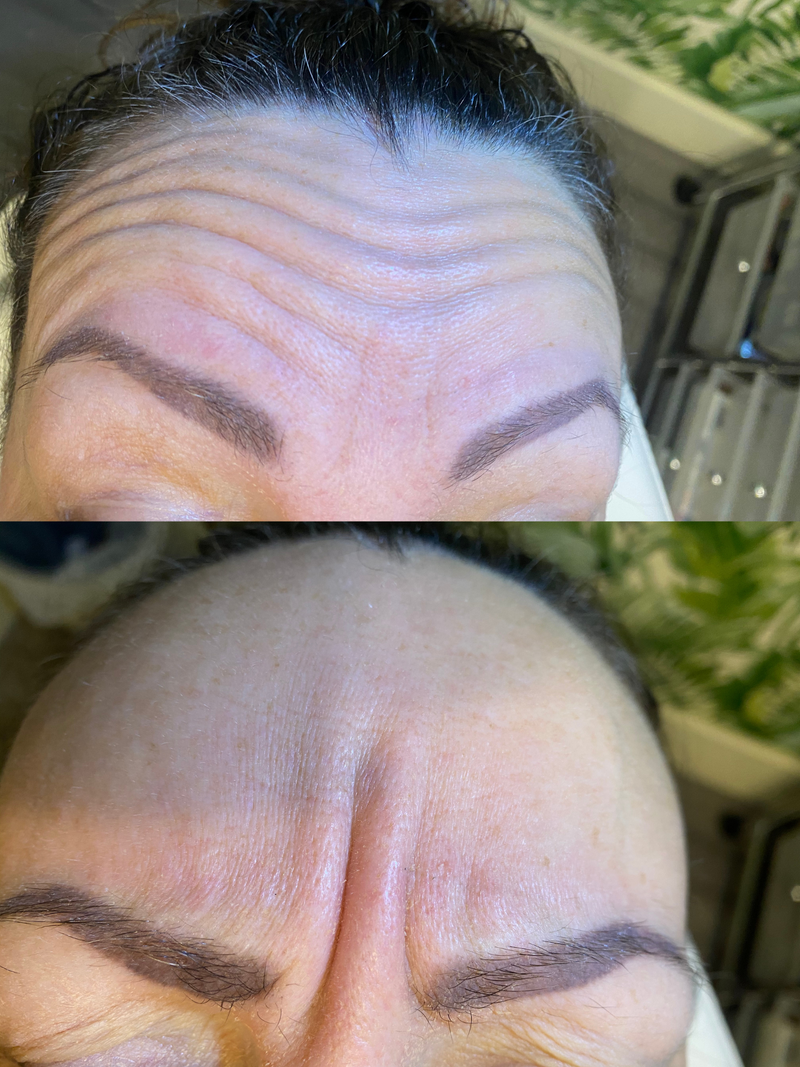 Anti wrinkle - Two Areas